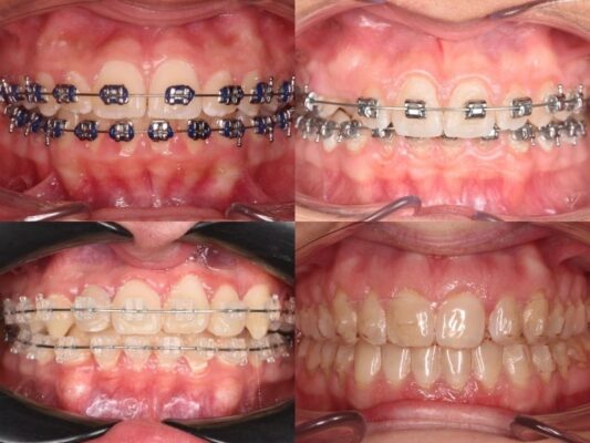 tipos ortodoncia