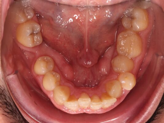 imagen de referencia post apiñamiento dental